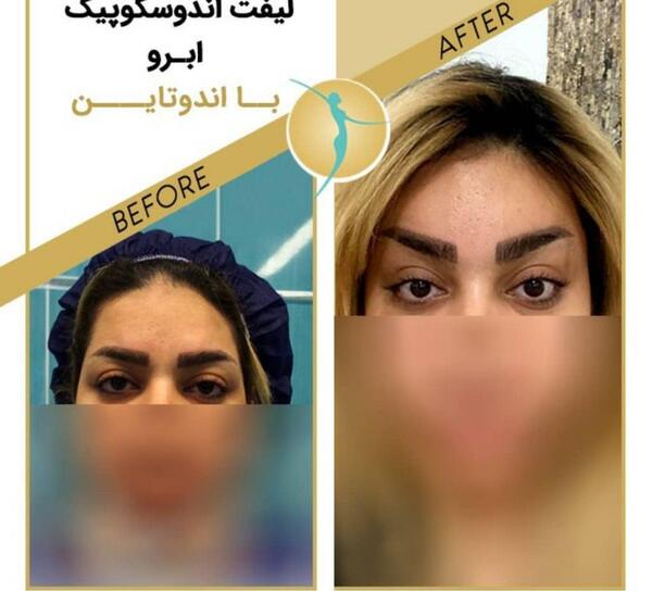 عکس قبل و بعد لیفت ابرو با نخ