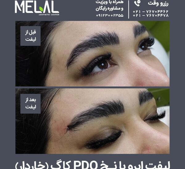 عکس قبل و بعد لیفت ابرو با نخ