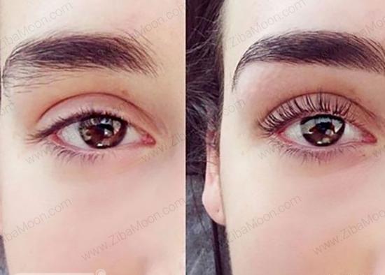 عکس قبل و بعد لیفت ابرو با مواد