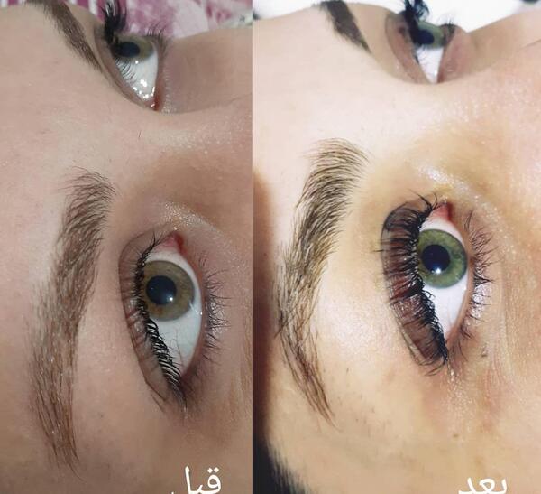 عکس قبل و بعد لیفت ابرو با مواد