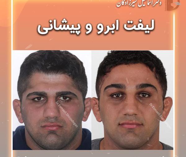 عکس قبل و بعد لیفت ابرو با مواد