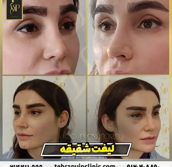 عکس قبل و بعد لیفت ابرو با مواد