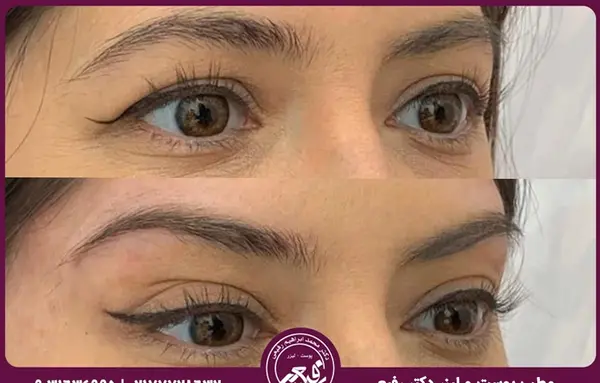 عکس قبل و بعد لیفت ابرو با مواد