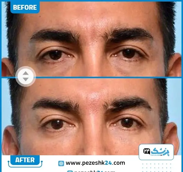 عکس قبل و بعد لیفت ابرو با بوتاکس