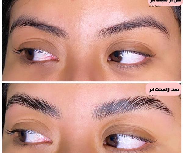 عکس قبل و بعد لیفت ابرو با بوتاکس