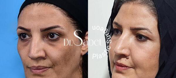 عکس قبل و بعد لیفت ابرو با بوتاکس