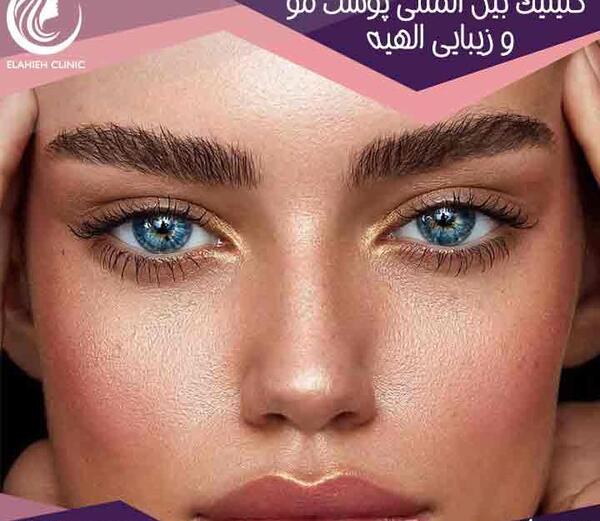 عکس قبل و بعد لیفت ابرو با بوتاکس