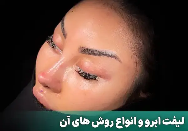 عکس قبل و بعد لیفت ابرو با بوتاکس