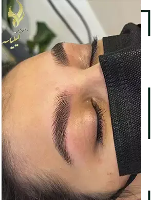 عکس قبل و بعد از لیفت ابرو