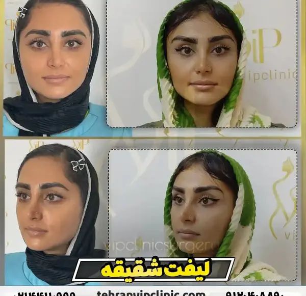 عکس قبل و بعد از لیفت ابرو