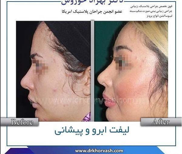 عکس قبل و بعد از لیفت ابرو