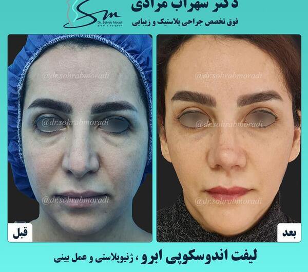 عکس قبل و بعد از لیفت ابرو