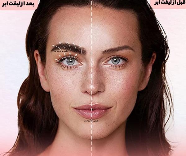 عکس قبل و بعد از لیفت ابرو