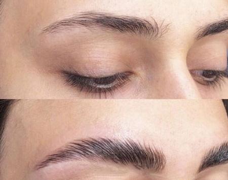 عکس قبل و بعد از لیفت ابرو