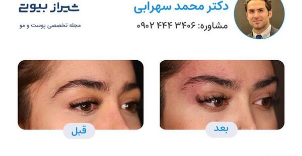 عکس قبل و بعد از لیفت ابرو