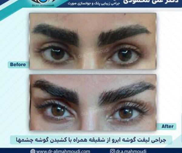 عکس قبل و بعد از لیفت ابرو
