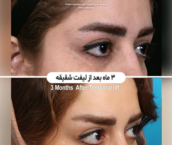 عکس قبل بعد لیفت ابرو