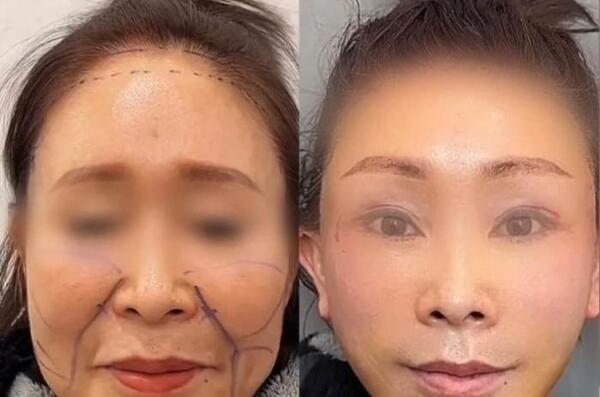 عکس قبل بعد لیفت ابرو