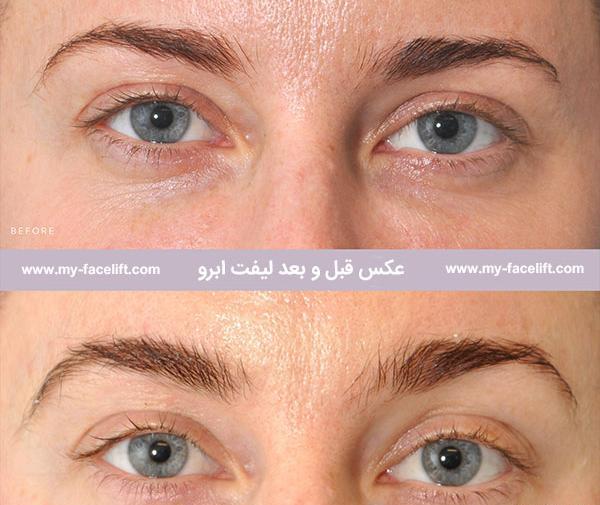 عکس قبل بعد لیفت ابرو