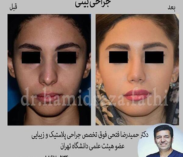 عکس های قبل و بعد عمل بینی گوشتی