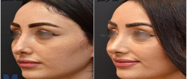 عکس های قبل و بعد عمل بینی گوشتی