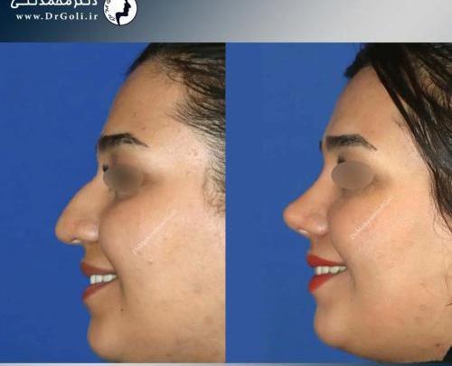 عکس های قبل و بعد عمل بینی گوشتی