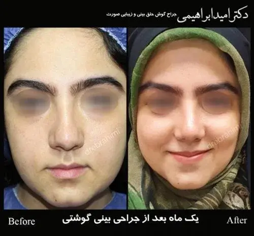 عکس های قبل و بعد عمل بینی گوشتی