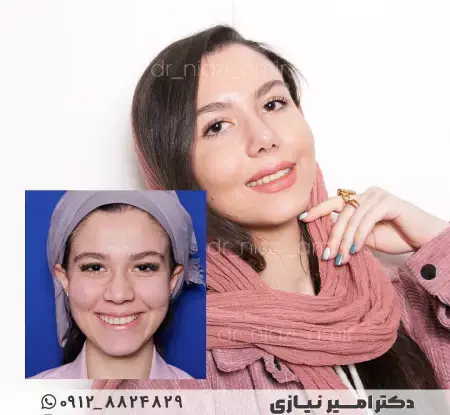 عکس های قبل و بعد عمل بینی گوشتی