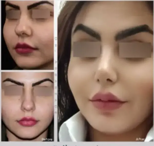 عکس های قبل و بعد عمل بینی گوشتی