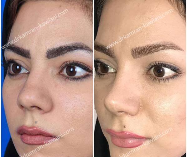 عکس های قبل و بعد عمل بینی گوشتی