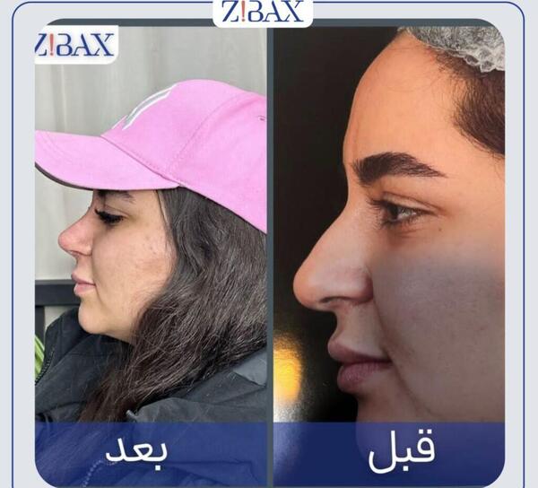 عکس های قبل و بعد عمل بینی گوشتی
