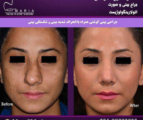 عکس های قبل و بعد عمل بینی گوشتی