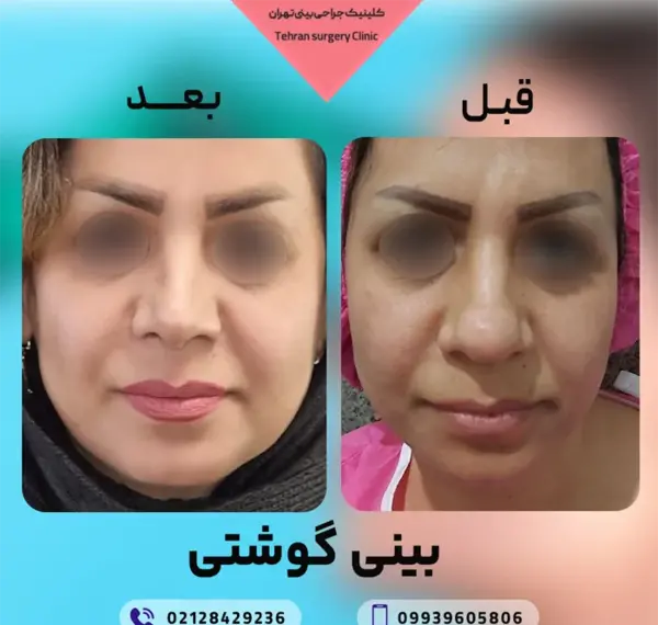 عکس های قبل و بعد عمل بینی گوشتی