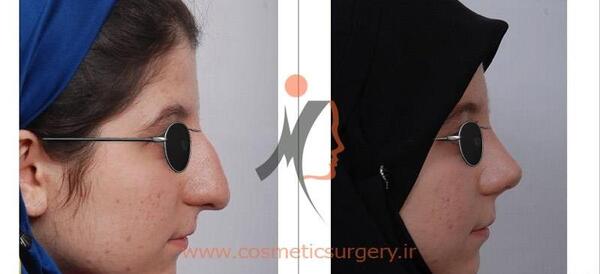 عکس های قبل و بعد عمل بینی گوشتی