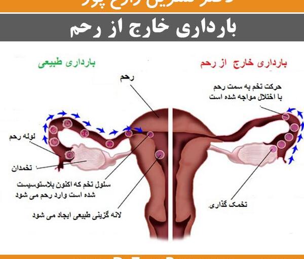 عکس بارداری خارج رحمی