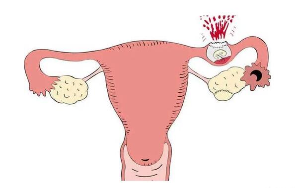 عکس بارداری خارج رحمی
