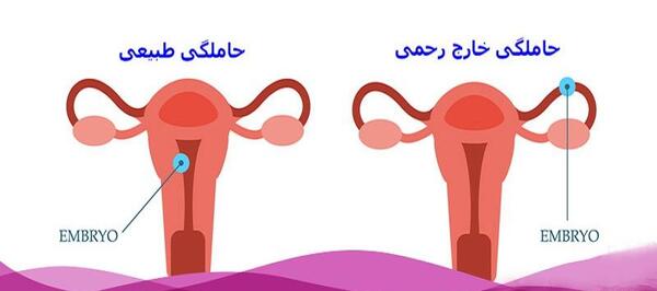 عکس بارداری خارج رحمی