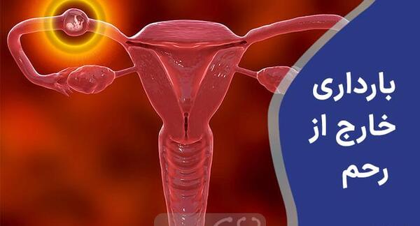 عکس بارداری خارج رحمی