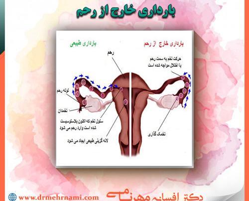 عکس بارداری خارج رحمی