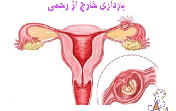 عکس بارداری خارج رحمی