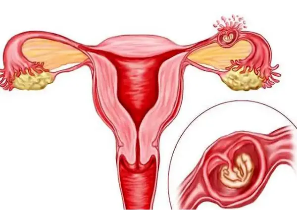 عکس بارداری خارج رحمی