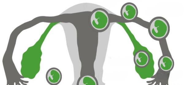 عکس بارداری خارج رحمی