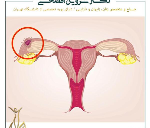 عکس بارداری خارج رحمی