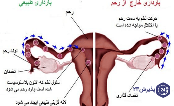 عکس بارداری خارج رحمی