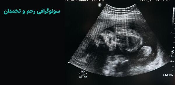 عکس سونوگرافی بارداری خارج رحم