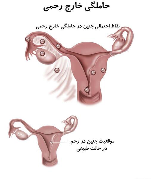 عکس سونوگرافی بارداری خارج رحم