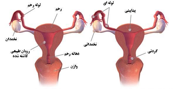 عکس سونوگرافی بارداری خارج رحم