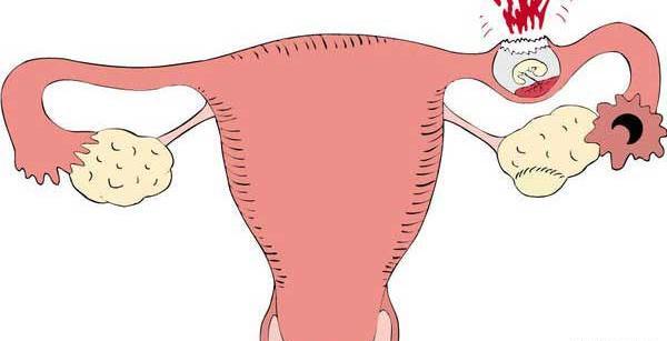 عکس سونوگرافی بارداری خارج رحم