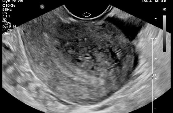 عکس سونوگرافی بارداری خارج از رحم