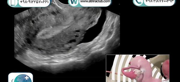 عکس سونوگرافی بارداری خارج از رحم
